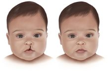 Cirugías gratuitas para personas con fisura de paladar y/o labio